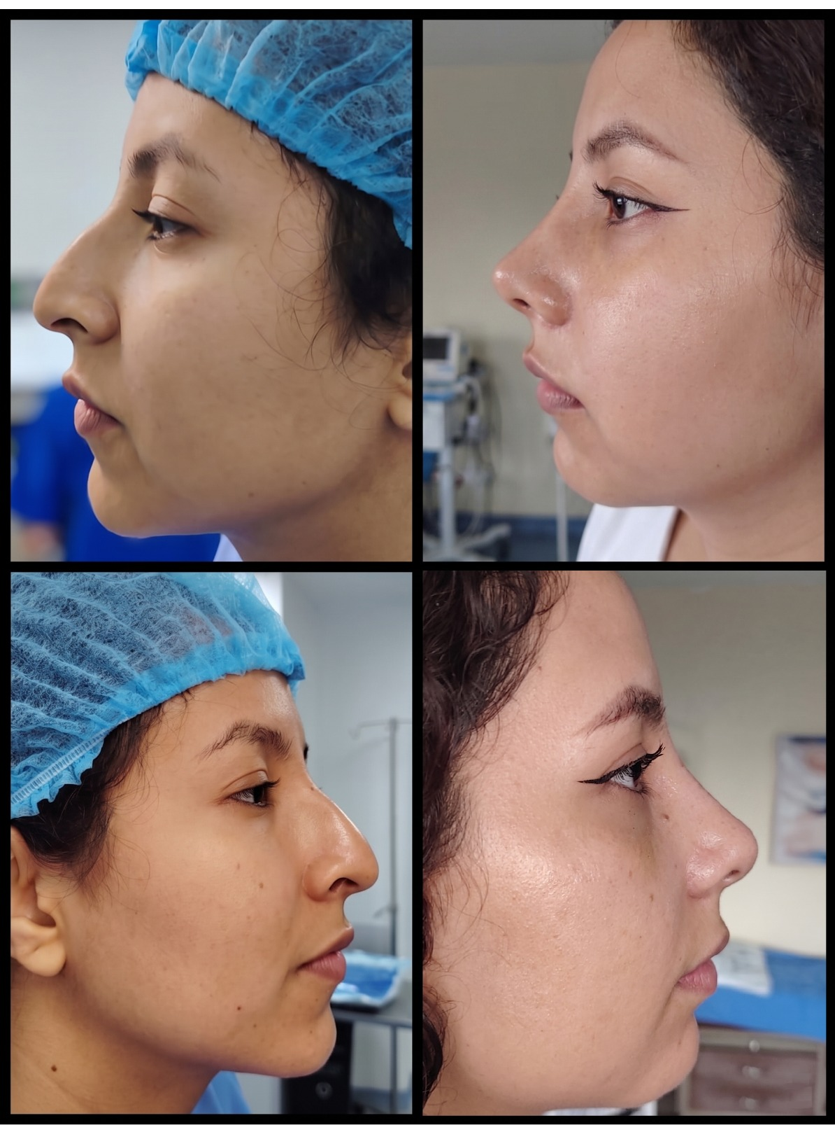 Caso clínico: resultado de rinoplastia primaria estética — corrección de giba dorsal, Guayaquil
